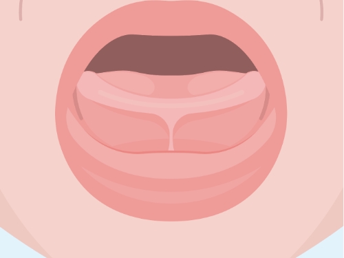Animated smile showing tongue tie