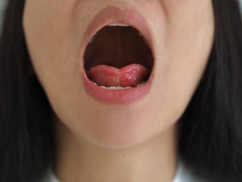 Person with lip and tongue tie
