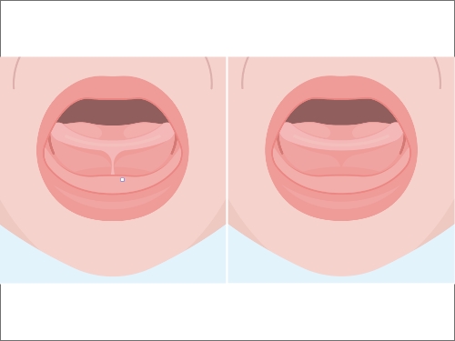 Animated smile before and after frenectomy