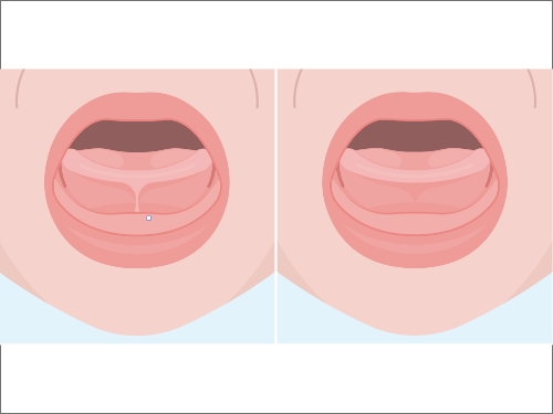 Animated smile before and after frenectomy