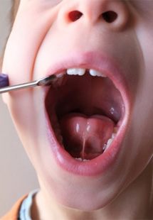 a child with a tongue tie that needs treatment