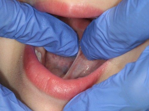 Closeup of mouth during examination as part of the frenectomy process