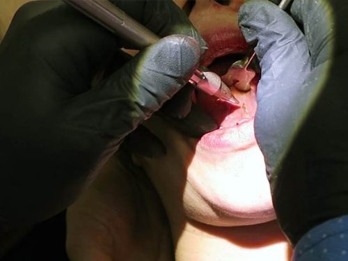 Specialist performing laser frenectomy