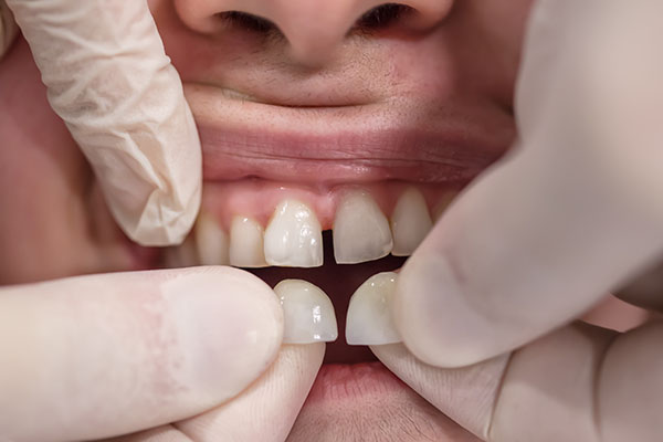 person going through last step of the veneer process